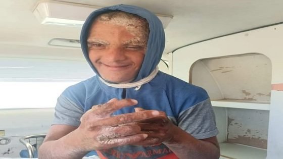 تدهور الوضع الصحي لشاب (من عين مديونة بتاونات) يعاني من إعاقة جراء مرض جلدي نادر