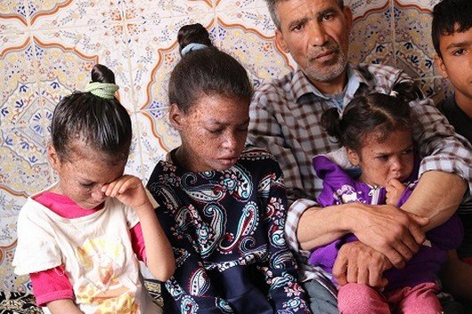 الفقر يسلب براءة أربع شقيقات من "أطفال القمر" ناحية تاونات
