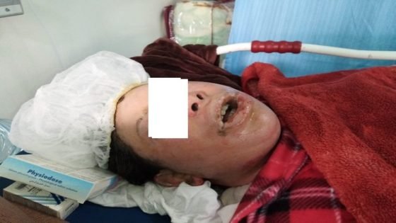 محنة زوجة بفاس..زوجها الذي يشتغل بتاونات سكب عليها كمية من الزيت الساخن أثناء نومها ويصيبها بحروق خطيرة