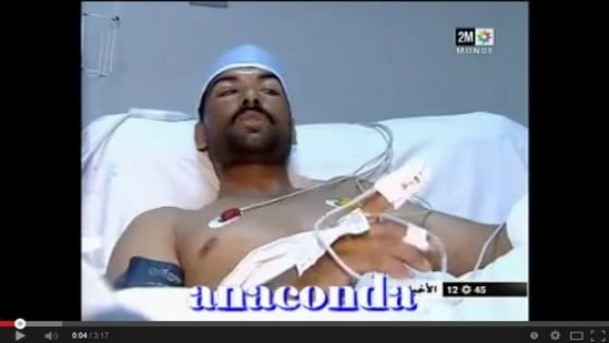 إعادة زرع كف مواطن من قرية أبا محمد في مستشفى جامعي بفاس في 5 ساعات