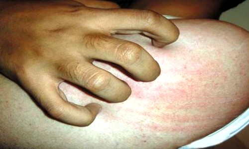 امراض الحكة الجلدية